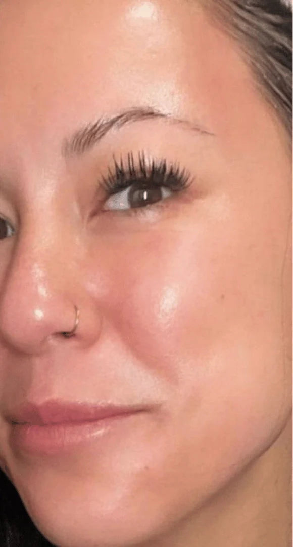 My Reactive Skin Finally Calmed Down